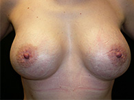 augmentation des seins chirurgie esthétique avant après photos