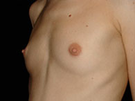 augmentation mammaire photos avant après opération chirurgie esthétique