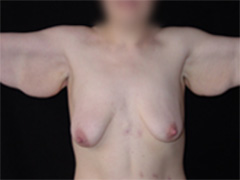 brachioplastie chirurgie esthétique des bras photo avant après