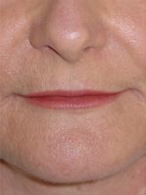 lifting du visage chirurgie esthétique des lèvres photos avant après