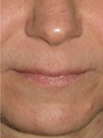 lifting du visage chirurgie esthétique des lèvres photos avant après