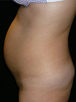 lipoaspiration abdominale photo avant après chirurgie du ventre