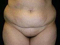lipoaspiration photo avant après chirurgie esthétique de l'abdomen
