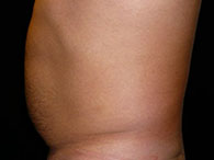 chirurgie esthétique du ventre photo avant après lipoaspiration abdominale