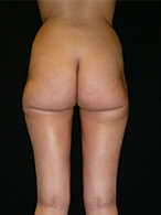 chirurgie esthétique des fesses photo avant après opération de lipoaspiration