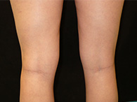 photo avant après chirurgie esthetique des genoux lipoaspiration