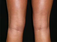 photo avant après chirurgie esthetique des genoux lipoaspiration