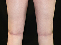 chirurgie esthétique des genoux lipoaspiration photo avant après