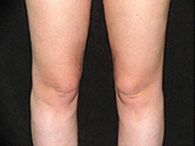 chirurgie esthétique des genoux photo avant après lipoaspiration
