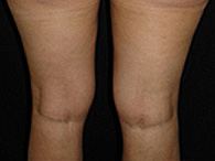 chirurgie esthétique des genoux photo avant après lipoaspiration