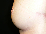 Photos avant après opération mamelons invaginés
