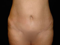 mini abdominoplastie photo avant après chirurgie du ventre
