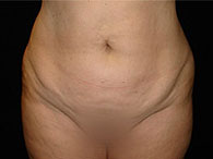 mini abdominoplastie photo avant après chirurgie du ventre