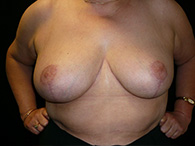 Photos avant après opération de réduction mammaire