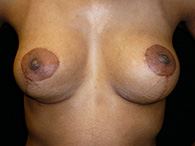 Mastopexie remodelage mammaire chirurgie esthétique photos avant après