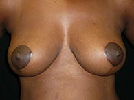 Mastopexie remodelage mammaire chirurgie esthétique photos avant après