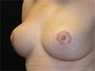 Photos avant après opération de remodelage mammaire mastopexie