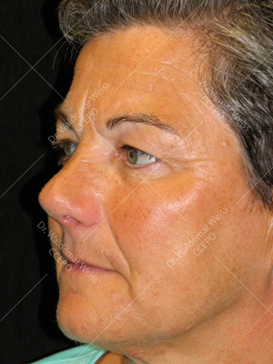 rhinoplastie de pointe chirurgie esthétique du nez avant après photos
