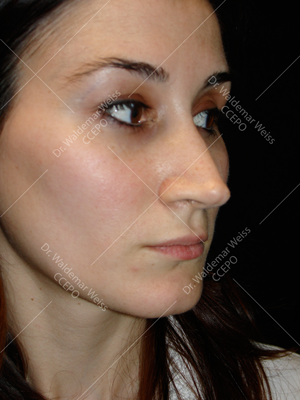 rhinoplastie de pointe chirurgie esthétique du nez avant après photos