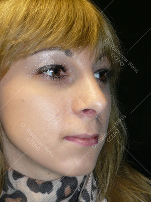 rhinoplastie chirurgie esthétique du nez photos avant après