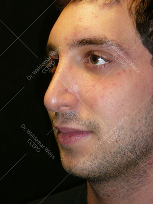 rhinoplastie chirurgie esthétique du nez photos avant après