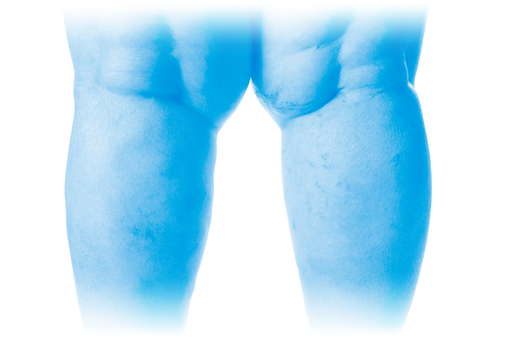 Chirurgie esthétique des genoux par le Docteur Weiss du CCEPO