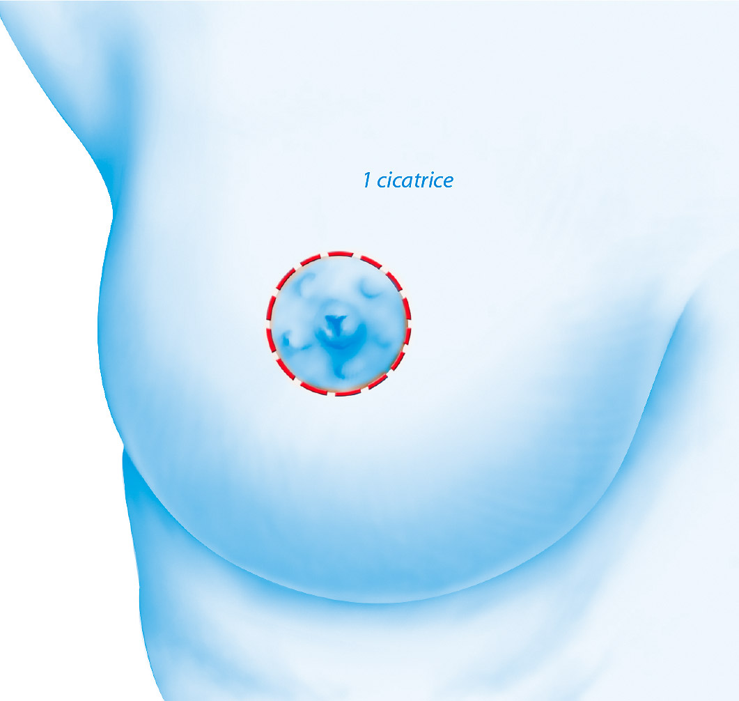 Chirurgie esthétique remodelages des seins par le Docteur Weiss du CCEPO 