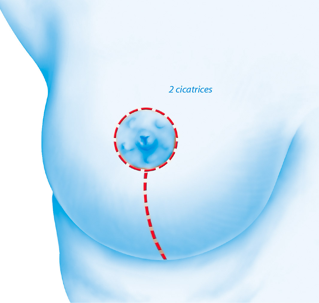Chirurgie esthétique remodelages des seins par le Docteur Weiss du CCEPO 