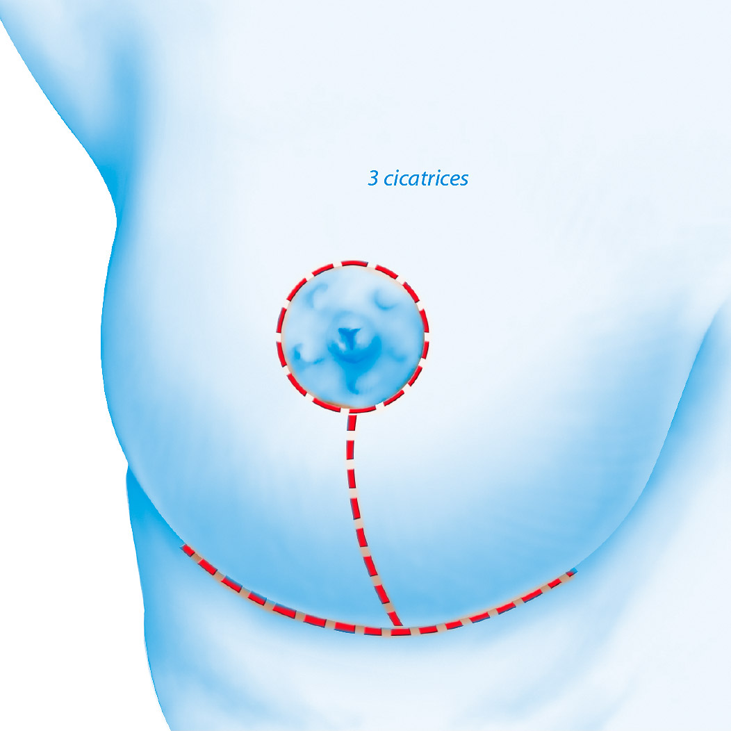 Chirurgie esthétique réduction des seins par le Docteur Weiss du CCEPO 