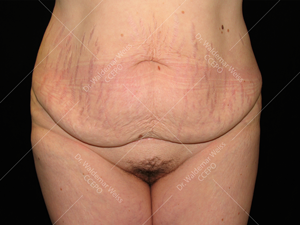 Abdominoplastie avant après, chirurgie du ventre — Dr Weiss Paris (cas 1)