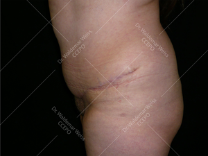 Abdominoplastie avant après, chirurgie du ventre — Dr Weiss Paris (cas 2)
