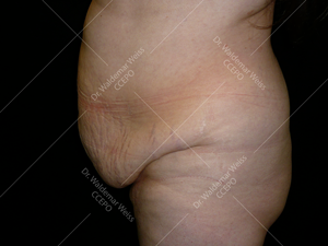 Abdominoplastie avant après, chirurgie du ventre — Dr Weiss Paris (cas 2)