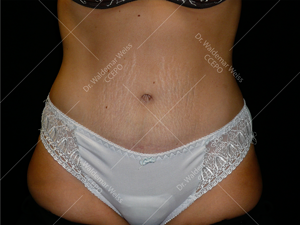 Abdominoplastie avant après, chirurgie du ventre — Dr Weiss Paris (cas 3)