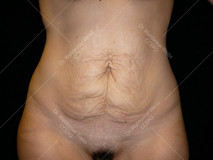 Abdominoplastie avant après, chirurgie du ventre — Dr Weiss Paris (cas 3)