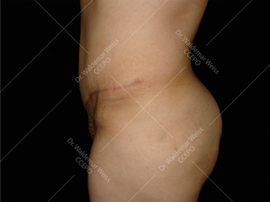 Abdominoplastie avant après, chirurgie du ventre — Dr Weiss Paris (cas 4)