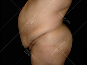 Abdominoplastie avant après, chirurgie du ventre — Dr Weiss Paris (cas 4)