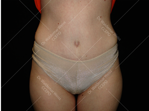 Abdominoplastie avant après, chirurgie du ventre — Dr Weiss Paris (cas 5)