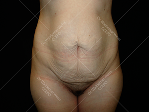 Abdominoplastie avant après, chirurgie du ventre — Dr Weiss Paris (cas 5)