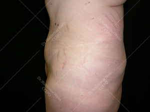 Abdominoplastie avant après, chirurgie du ventre — Dr Weiss Paris (cas 7)