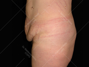 Abdominoplastie avant après, chirurgie du ventre — Dr Weiss Paris (cas 7)