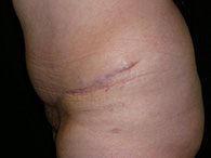 Abdominoplastie avant après, chirurgie du ventre — Dr Weiss Paris (cas 8)