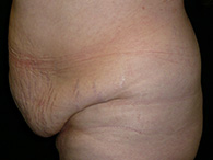 Abdominoplastie avant après, chirurgie du ventre — Dr Weiss Paris (cas 8)