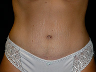 Abdominoplastie avant après, chirurgie du ventre — Dr Weiss Paris (cas 9)