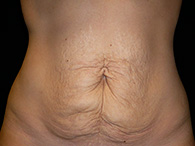 Abdominoplastie avant après, chirurgie du ventre — Dr Weiss Paris (cas 9)