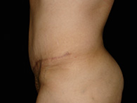 Abdominoplastie avant après, chirurgie du ventre — Dr Weiss Paris (cas 10)