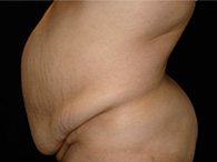 Abdominoplastie avant après, chirurgie du ventre — Dr Weiss Paris (cas 10)