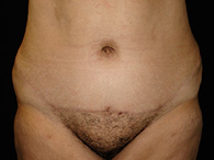 Abdominoplastie avant après, chirurgie du ventre — Dr Weiss Paris (cas 11)