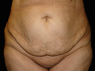 Abdominoplastie avant après, chirurgie du ventre — Dr Weiss Paris (cas 11)