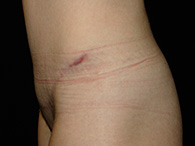 Abdominoplastie avant après, chirurgie du ventre — Dr Weiss Paris (cas 12)