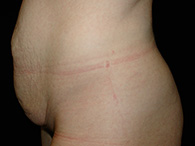 Abdominoplastie avant après, chirurgie du ventre — Dr Weiss Paris (cas 12)